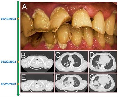 Case report: From oral infection to life-threatening pneumonia: clinical considerations in Nocardia infection from a case